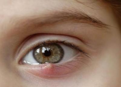 تفاوت های گل مژه و شالازیون در چیست؟ تفاوت های گل مژه و شالازیون در چیست؟